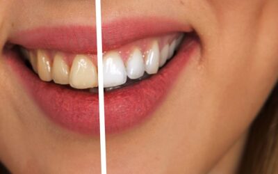 I dentifrici sbiancanti